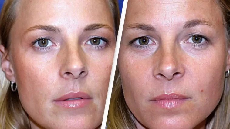 Identical Twins Reveal Surprising Results After 20 Years of Botox Versus Natural Aging