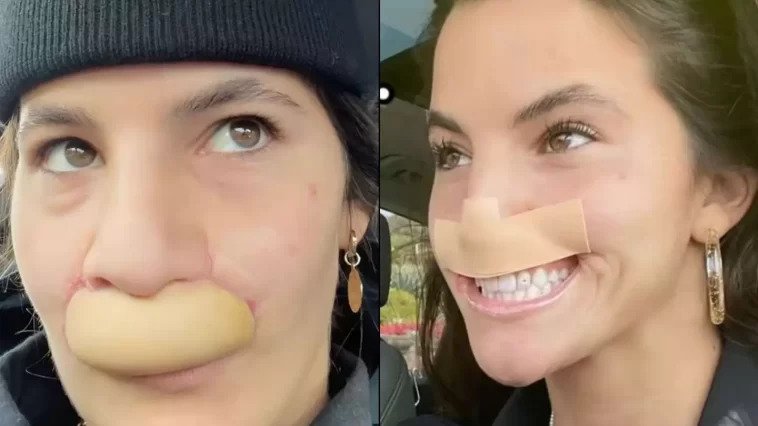 Model whose lip was bitten off by dog shows off transformation after six surgeries