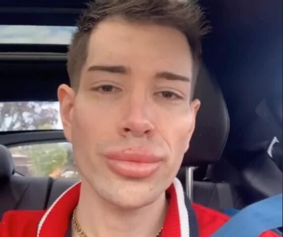 Man Shocks the Internet with His Plastic Surgery Transformation