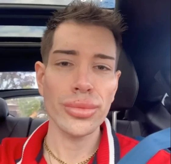 Man Shocks the Internet with His Plastic Surgery Transformation